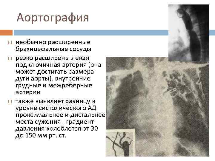 Аортография необычно расширенные брахицефальные сосуды резко расширены левая подключичная артерия (она может достигать размера