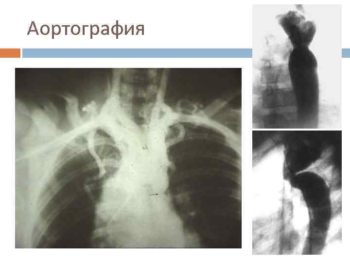 Аортография