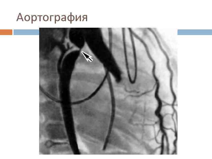 Аортография