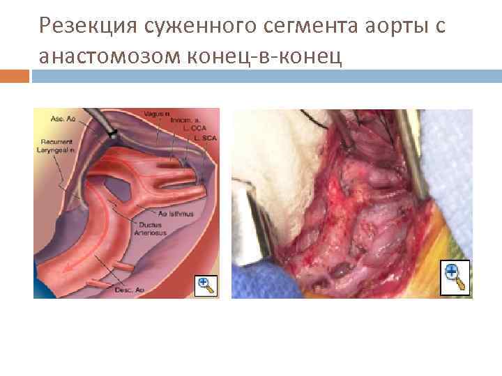 Резекция суженного сегмента аорты с анастомозом конец-в-конец 