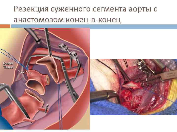 Резекция суженного сегмента аорты с анастомозом конец-в-конец 