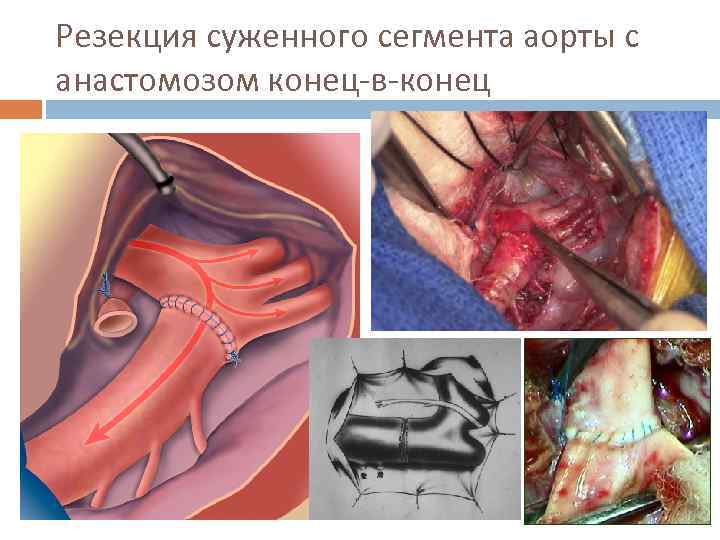 Резекция суженного сегмента аорты с анастомозом конец-в-конец 