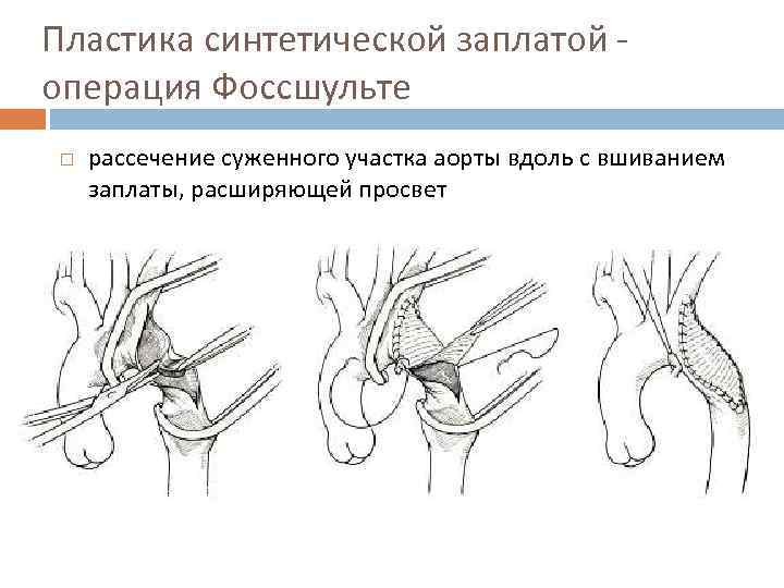 Пластика синтетической заплатой - операция Фоссшульте рассечение суженного участка аорты вдоль с вшиванием заплаты,