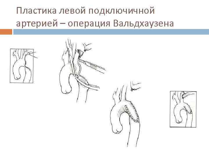 Сонно подключичное шунтирование схема операции