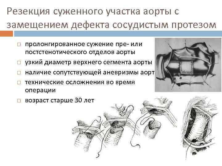 Резекция суженного участка аорты с замещением дефекта сосудистым протезом пролонгированное сужение пре- или постстенотического