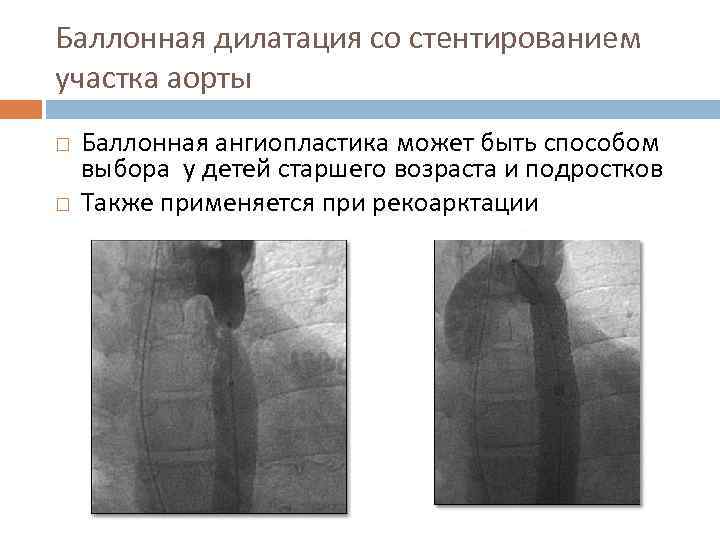 Баллонная дилатация со стентированием участка аорты Баллонная ангиопластика может быть способом выбора у детей