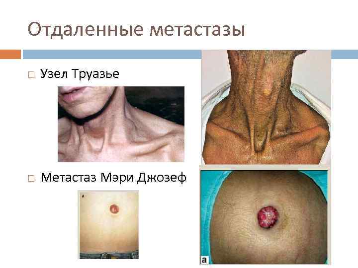 Отдаленные метастазы Узел Труазье Метастаз Мэри Джозеф 