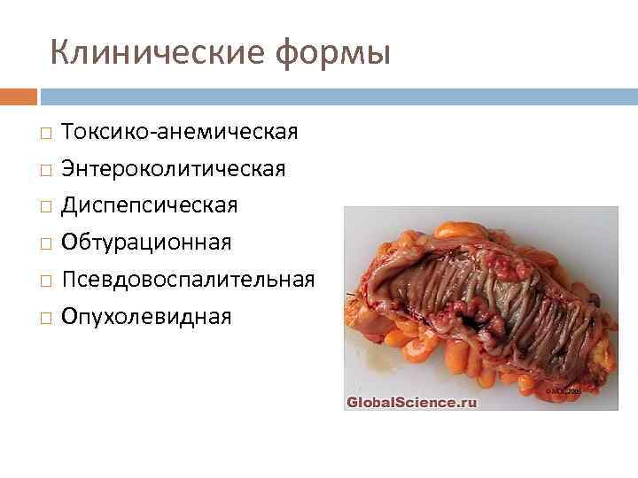 Клинические формы Токсико-анемическая Энтероколитическая Диспепсическая Обтурационная Псевдовоспалительная Опухолевидная 