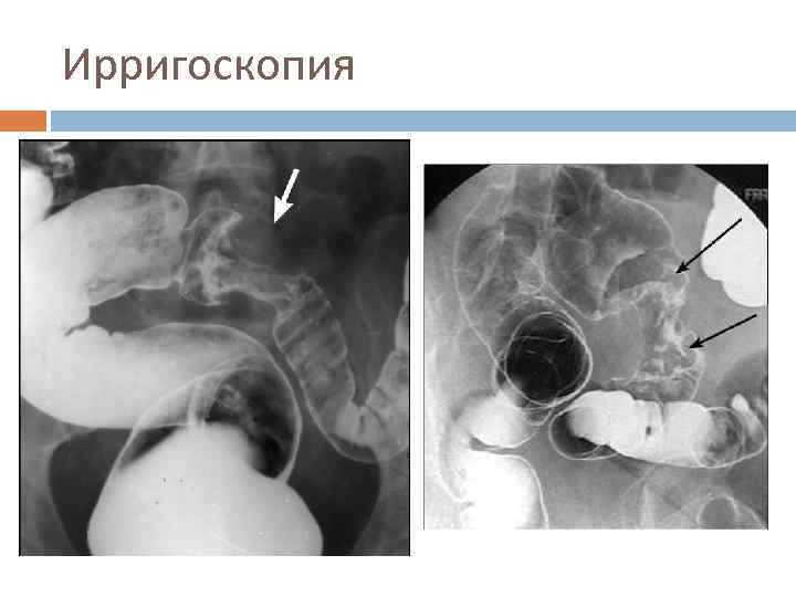 Ирригоскопия кишечника что это