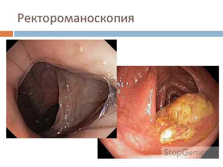 Ректороманоскопия 