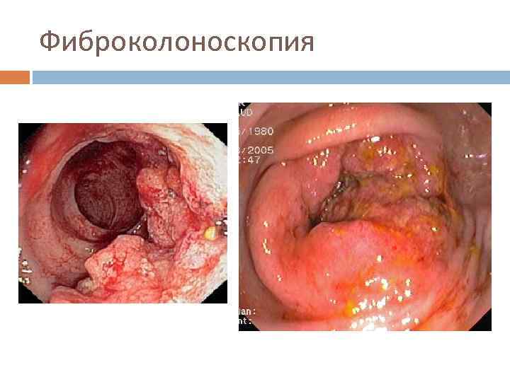 Фиброколоноскопия 