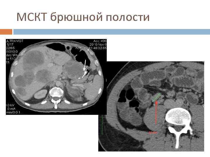 МСКТ брюшной полости 