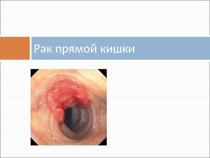 Рак прямой кишки 