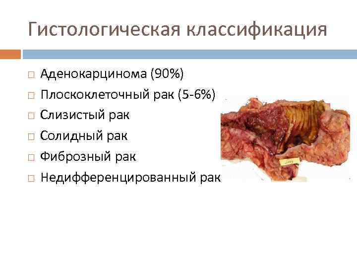 Гистологическая классификация Аденокарцинома (90%) Плоскоклеточный рак (5 -6%) Слизистый рак Солидный рак Фиброзный рак