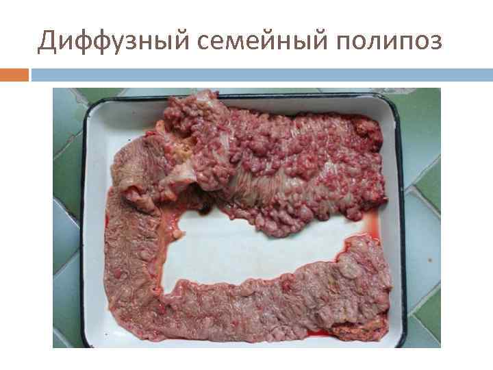 Диффузный семейный полипоз 