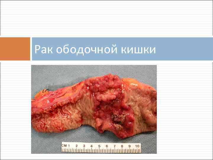 Рак ободочной кишки 