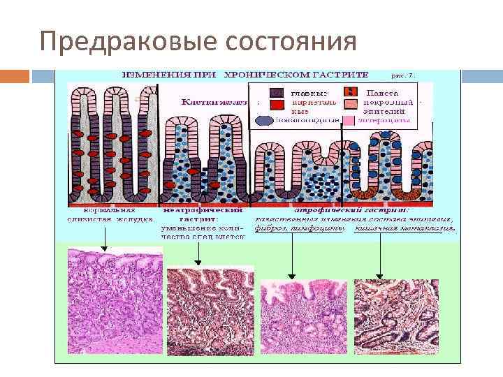 Предраковые заболевания желудка презентация