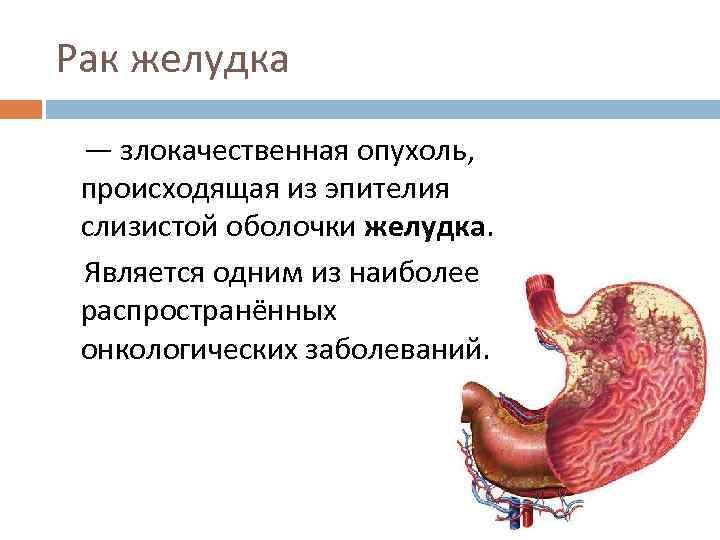 Онкология желудка 4 стадия. Злокачественная опухоль желудка. Новообразование на слизистой желудка. Опухоль слизистой желудка.