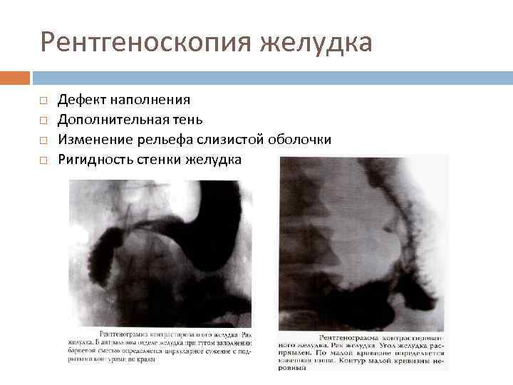 Рентгеноскопия желудка Дефект наполнения Дополнительная тень Изменение рельефа слизистой оболочки Ригидность стенки желудка 