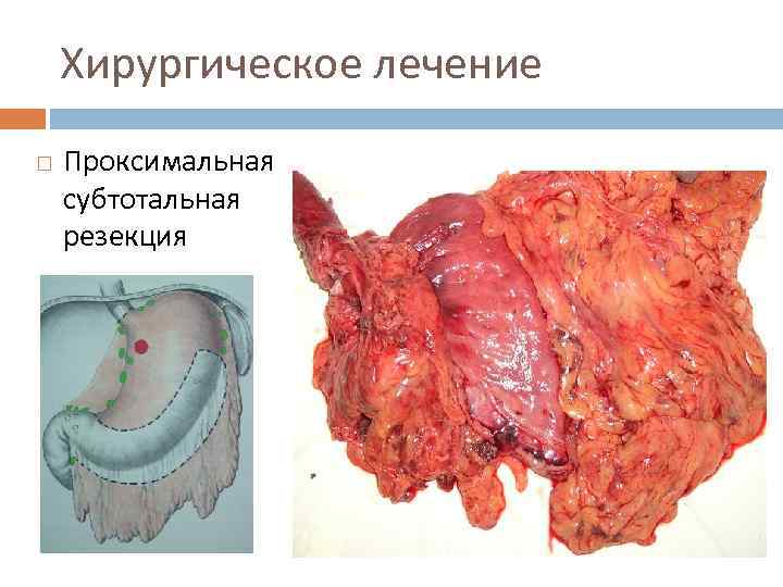 Хирургическое лечение Проксимальная субтотальная резекция 