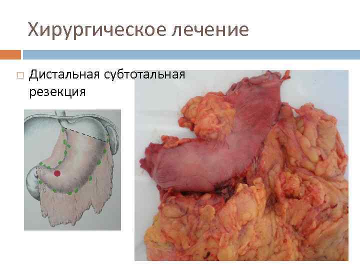 Хирургическое лечение Дистальная субтотальная резекция 