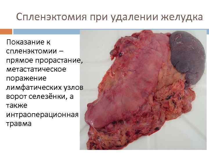 Спленэктомия при удалении желудка Показание к спленэктомии – прямое прорастание, метастатическое поражение лимфатических узлов