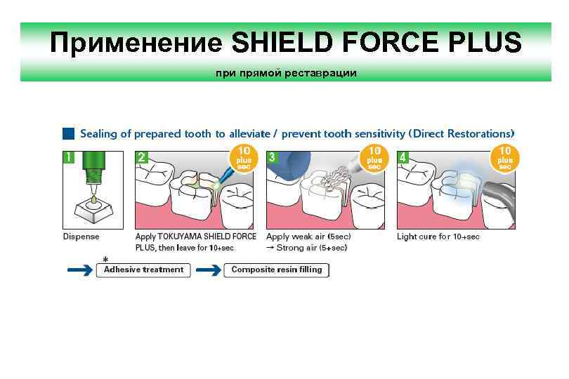 Применение SHIELD FORCE PLUS при прямой реставрации 