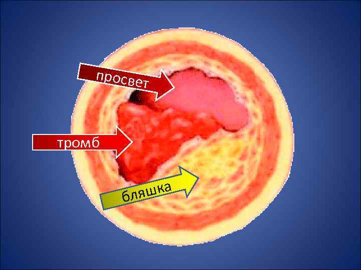 просве т тромб шка бля 