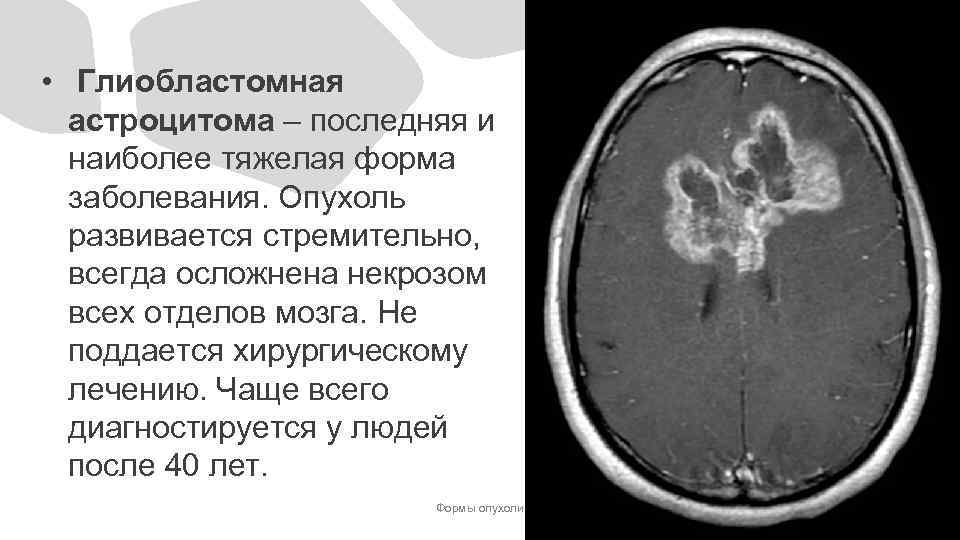  • Глиобластомная астроцитома – последняя и наиболее тяжелая форма заболевания. Опухоль развивается стремительно,