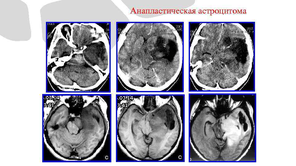 Анапластическая астроцитома 