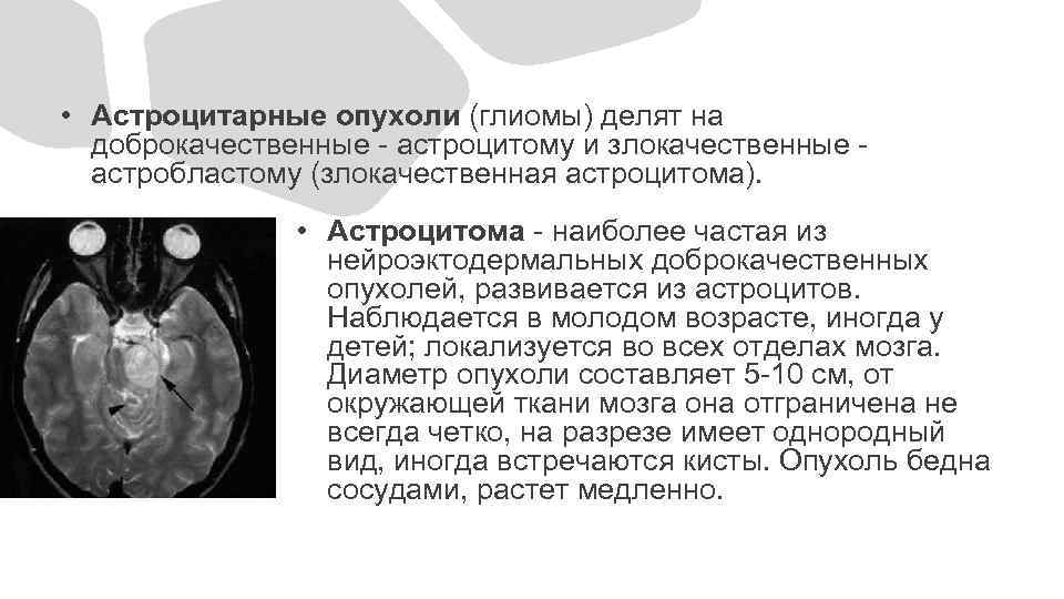  • Астроцитарные опухоли (глиомы) делят на доброкачественные - астроцитому и злокачественные - астробластому