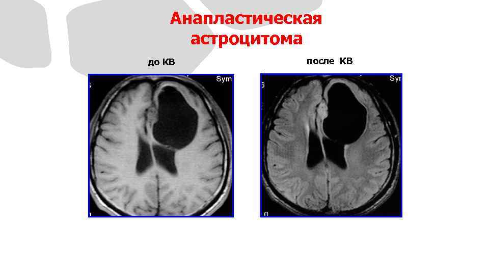 Анапластическая астроцитома до КВ после КВ На МРТ до и после усиления четко представлено