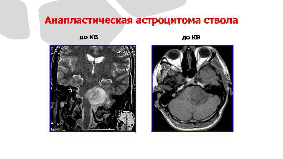 Анапластическая астроцитома ствола до КВ 