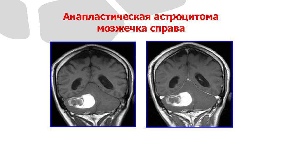 Анапластическая астроцитома мозжечка справа до КВ после КВ 