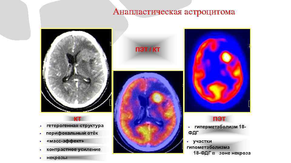 Анапластическая астроцитома ПЭТ / КТ § гетерогенная структура § ПЭТ перифокальный отёк § «масс-эффект»