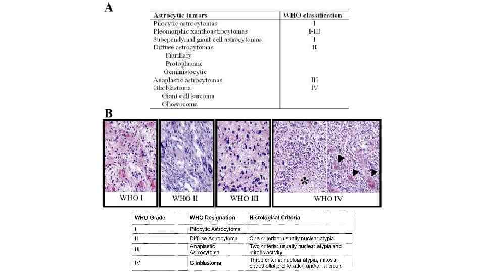 Астроцитома грейд. Фибриллярная астроцитома гистология. Астроцитома описание микропрепарата. Анапластическая астроцитома Grade 3 головного мозга гистология. Пилоцитарная астроцитома гистология.