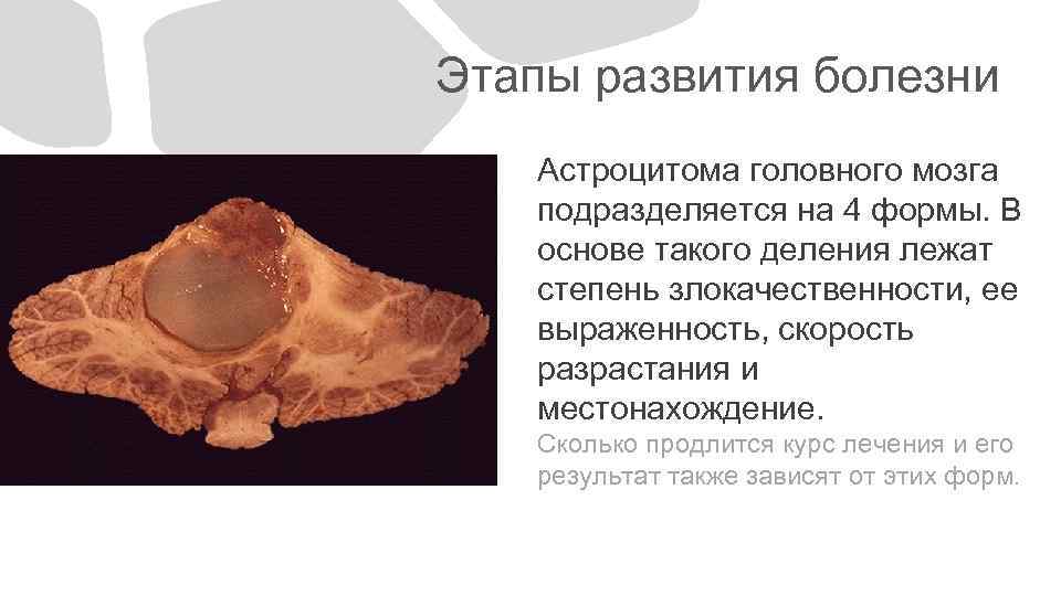  Этапы развития болезни Астроцитома головного мозга подразделяется на 4 формы. В основе такого