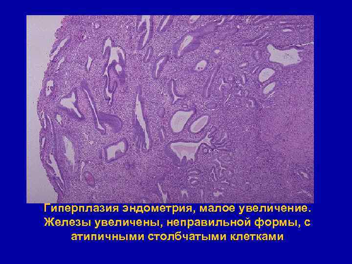 Гиперплазия эндометрия, малое увеличение. Железы увеличены, неправильной формы, с атипичными столбчатыми клетками 