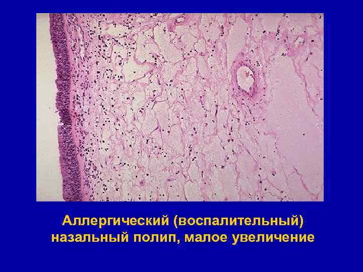 Аллергический (воспалительный) назальный полип, малое увеличение 