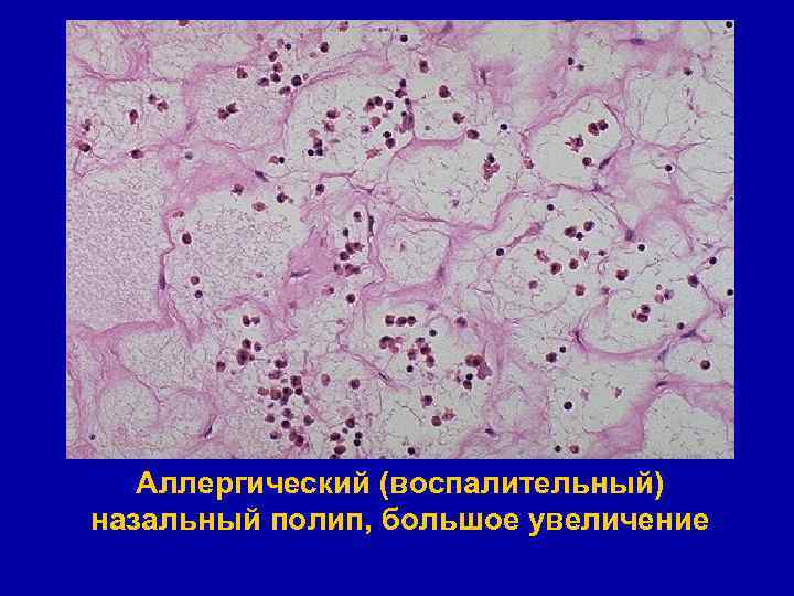 Аллергический (воспалительный) назальный полип, большое увеличение 