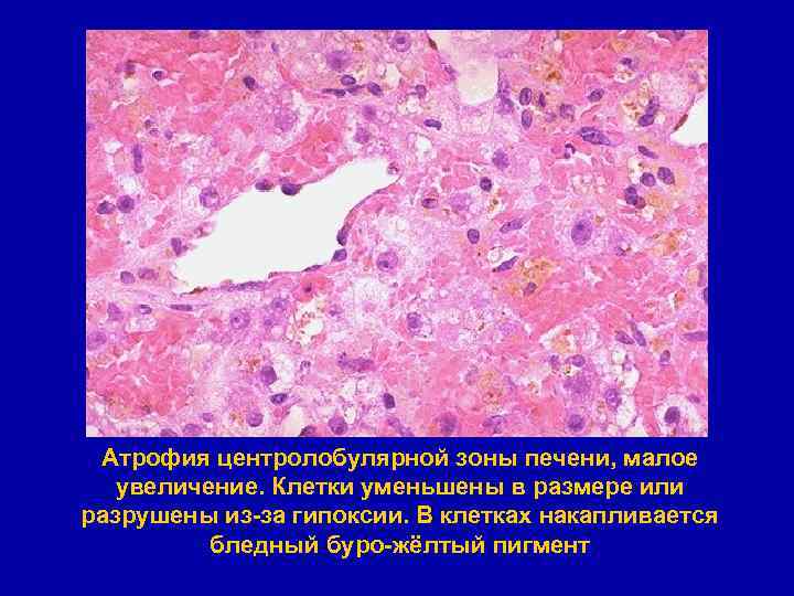Атрофия центролобулярной зоны печени, малое увеличение. Клетки уменьшены в размере или разрушены из-за гипоксии.