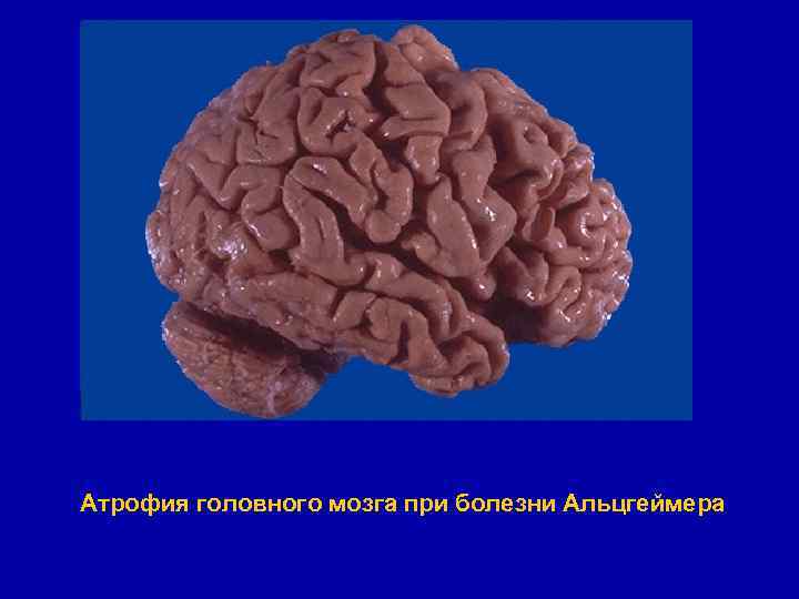 Атрофия головного мозга при болезни Альцгеймера 