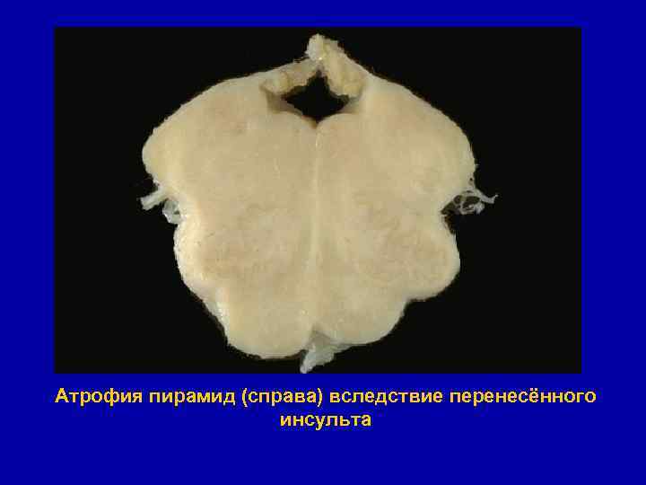 Атрофия пирамид (справа) вследствие перенесённого инсульта 