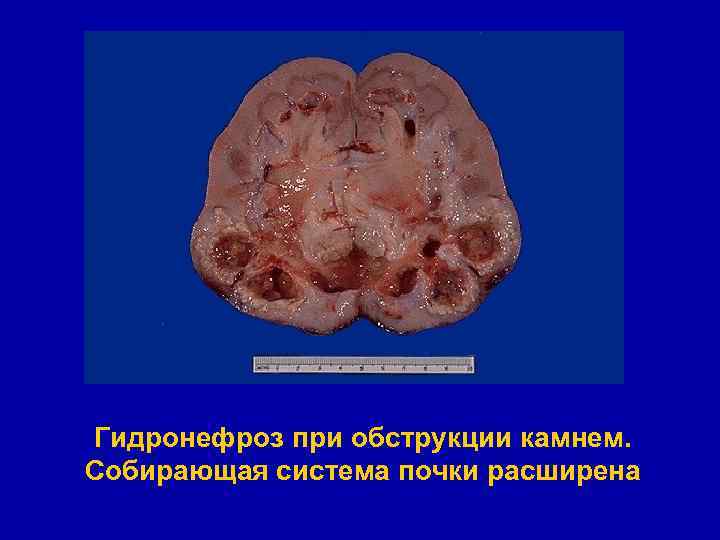 Гидронефроз при обструкции камнем. Собирающая система почки расширена 