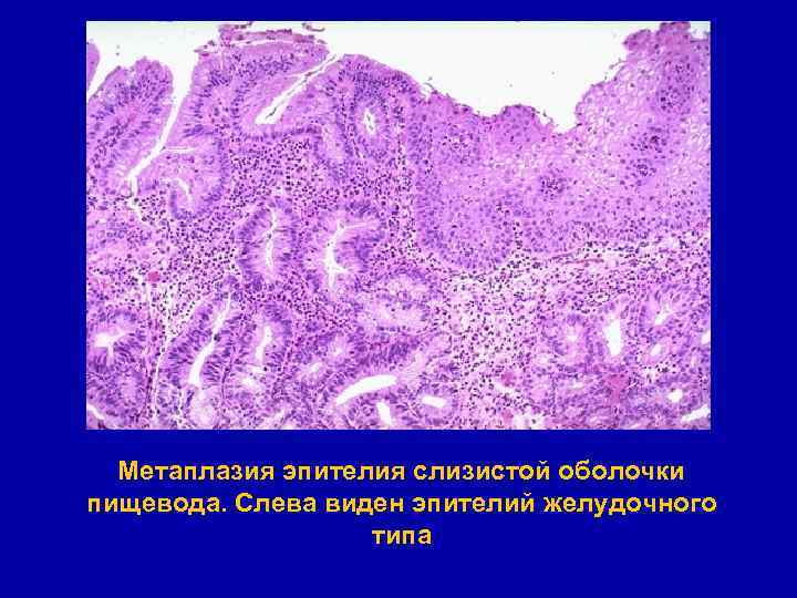 Метаплазия эпителия слизистой оболочки пищевода. Слева виден эпителий желудочного типа 