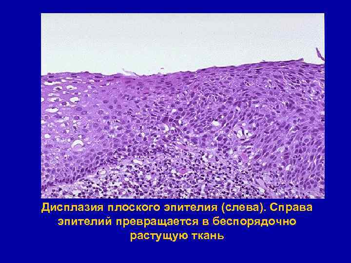 Дисплазия плоского эпителия (слева). Справа эпителий превращается в беспорядочно растущую ткань 