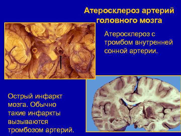 Атеросклероз артерий головного мозга Атеросклероз с тромбом внутренней сонной артерии. Острый инфаркт мозга. Обычно