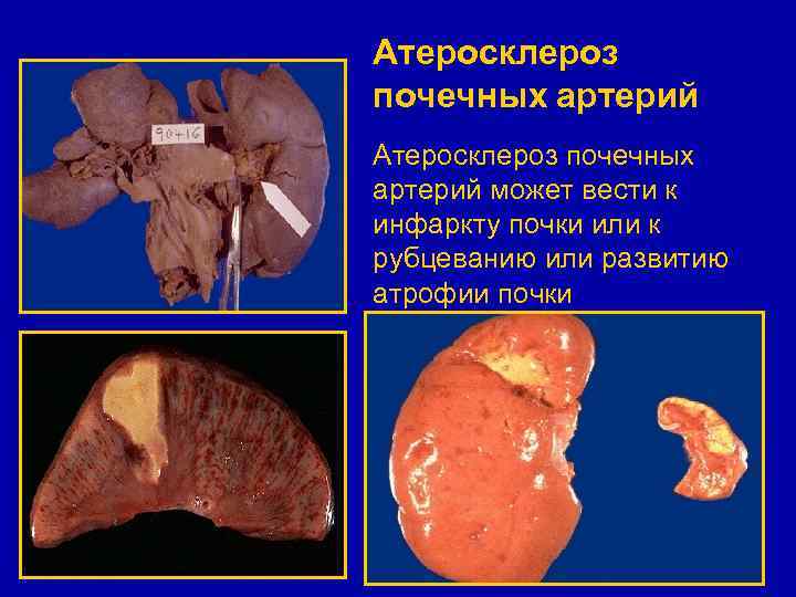 Атеросклероз почечных артерий может вести к инфаркту почки или к рубцеванию или развитию атрофии