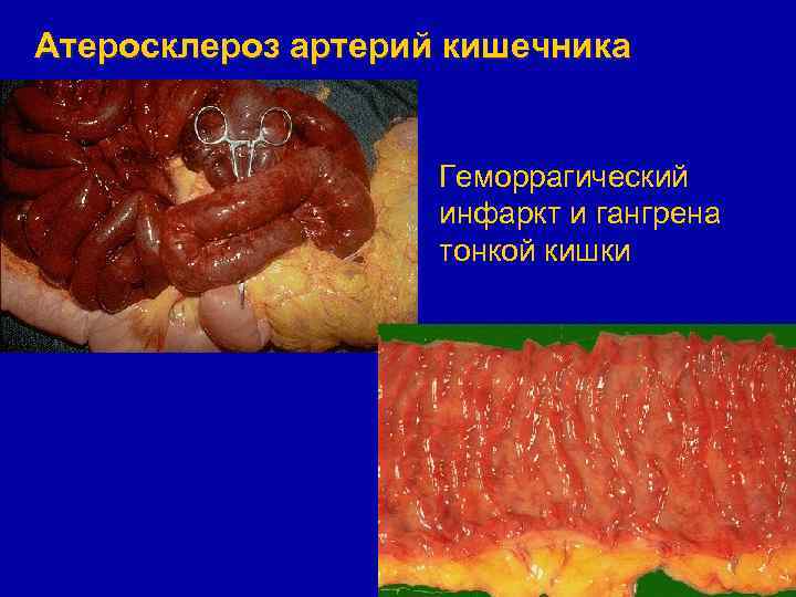 Атеросклероз артерий кишечника Геморрагический инфаркт и гангрена тонкой кишки 