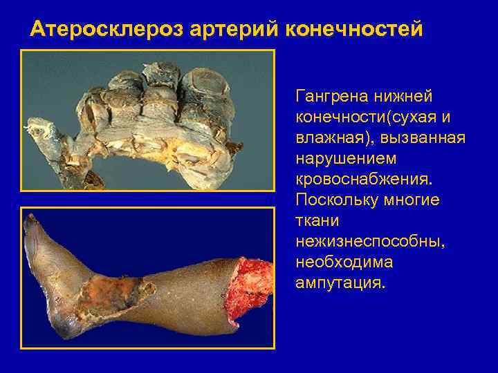 Атеросклероз артерий конечностей Гангрена нижней конечности(сухая и влажная), вызванная нарушением кровоснабжения. Поскольку многие ткани